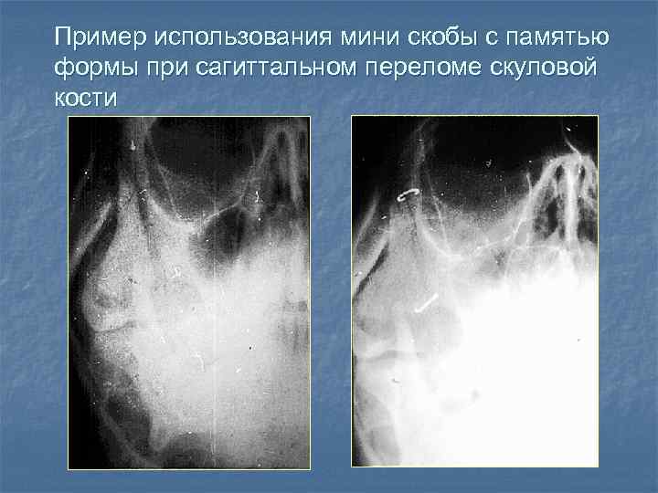 Пример использования мини скобы с памятью формы при сагиттальном переломе скуловой кости 