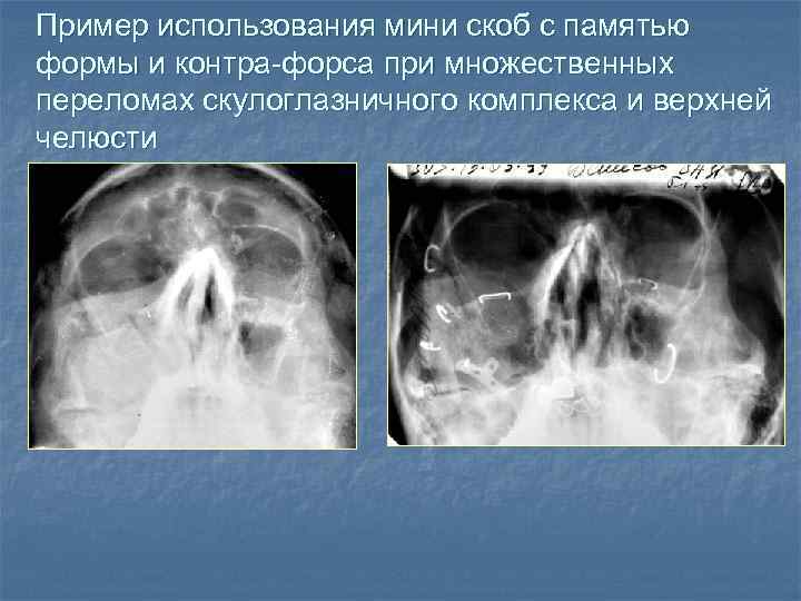 Пример использования мини скоб с памятью формы и контра-форса при множественных переломах скулоглазничного комплекса
