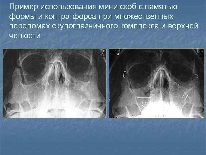 Приобретенные деформации скулоорбитального комплекса и носа презентация