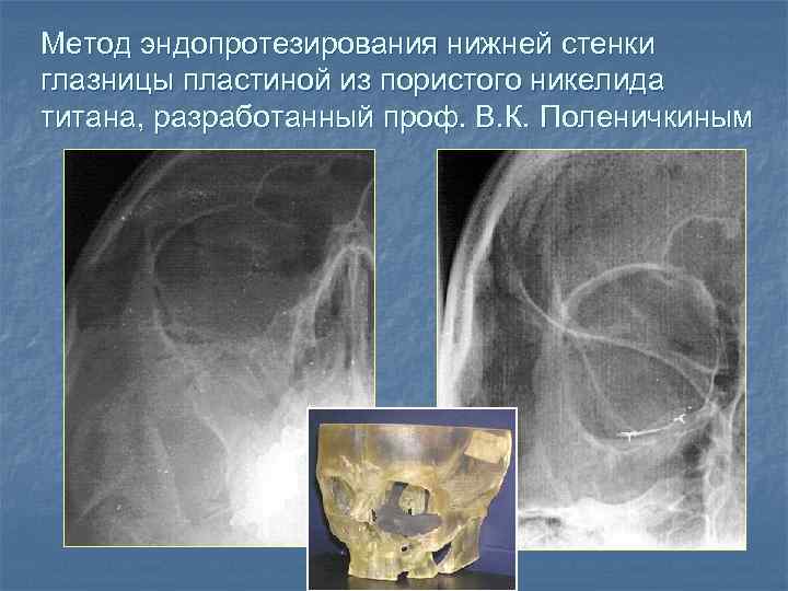 Метод эндопротезирования нижней стенки глазницы пластиной из пористого никелида титана, разработанный проф. В. К.