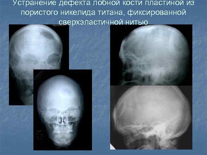 Устранение дефекта лобной кости пластиной из пористого никелида титана, фиксированной сверхэластичной нитью 