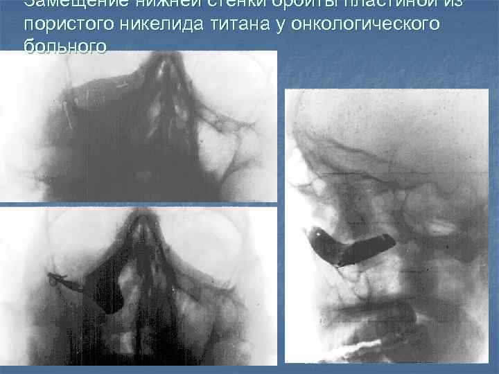 Замещение нижней стенки орбиты пластиной из пористого никелида титана у онкологического больного 