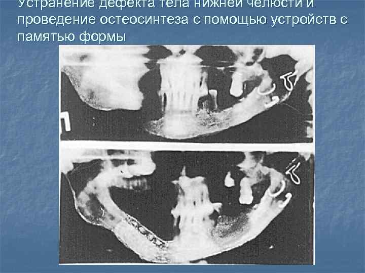 Устранение дефекта тела нижней челюсти и проведение остеосинтеза с помощью устройств с памятью формы