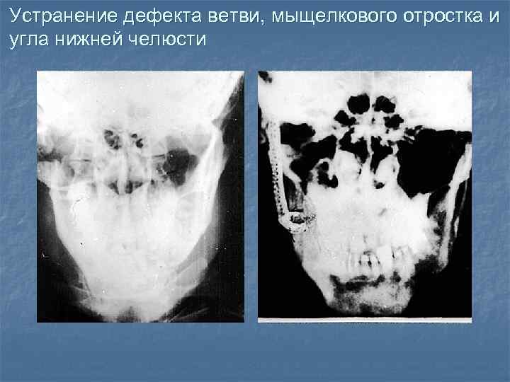 Устранение дефекта ветви, мыщелкового отростка и угла нижней челюсти 