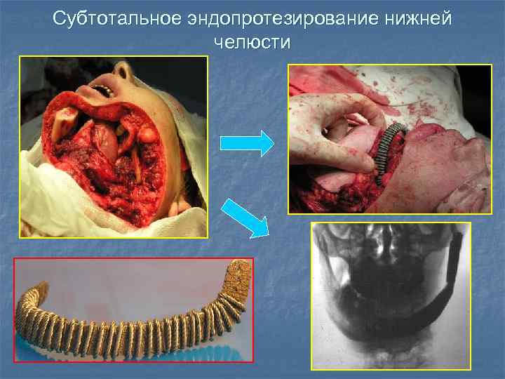 Субтотальное эндопротезирование нижней челюсти 