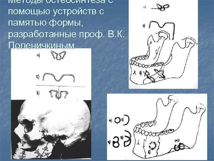 Методы остеосинтеза с помощью устройств с памятью формы, разработанные проф. В. К. Поленичкиным 