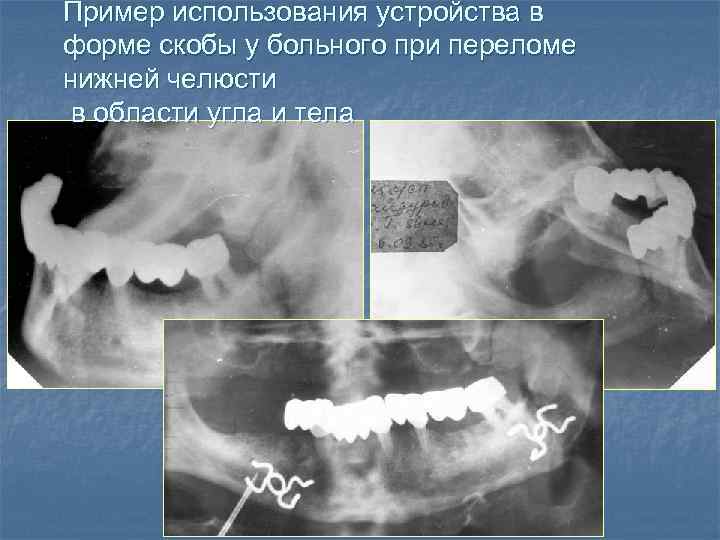 Пример использования устройства в форме скобы у больного при переломе нижней челюсти в области