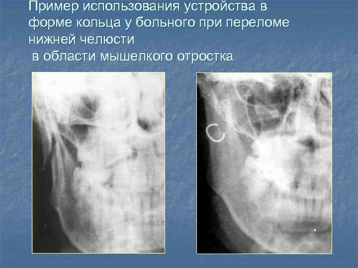 Пример использования устройства в форме кольца у больного при переломе нижней челюсти в области