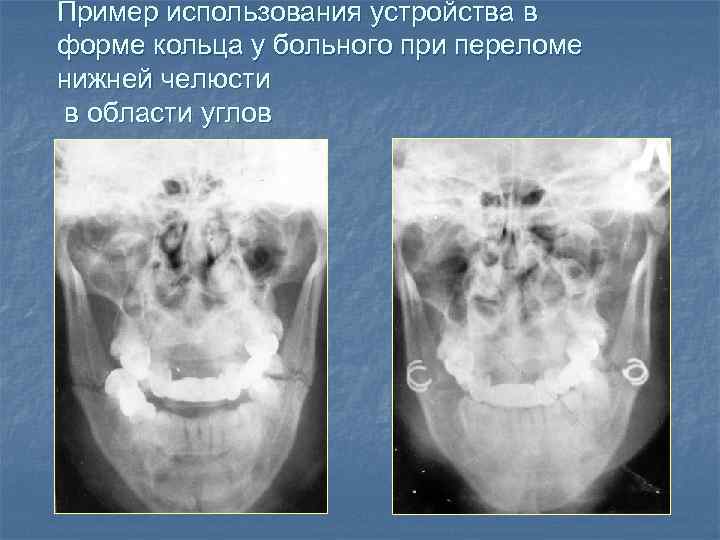 Пример использования устройства в форме кольца у больного при переломе нижней челюсти в области