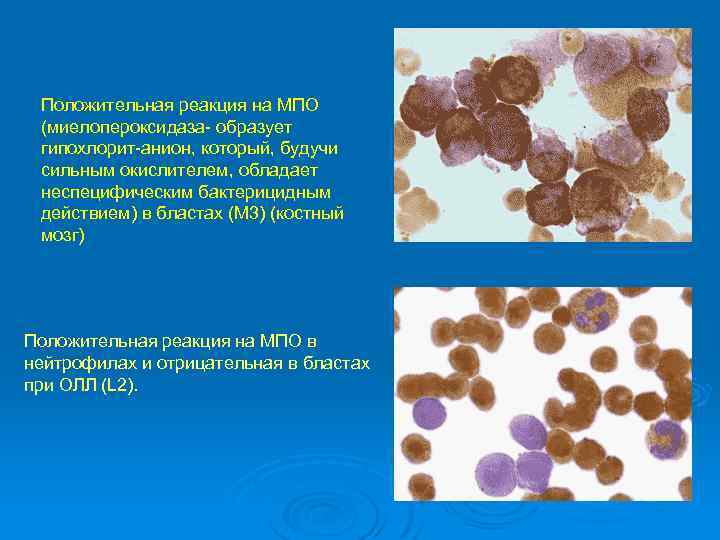 Положительная реакция на МПО (миелопероксидаза образует гипохлорит анион, который, будучи сильным окислителем, обладает неспецифическим