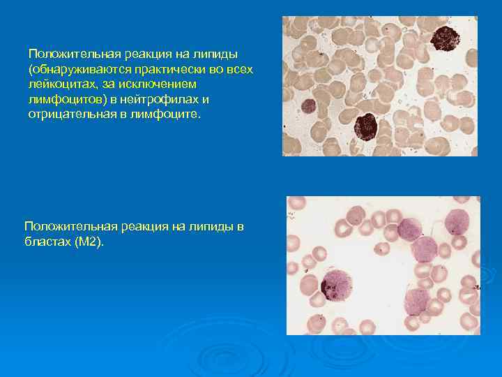 Положительная реакция на липиды (обнаруживаются практически во всех лейкоцитах, за исключением лимфоцитов) в нейтрофилах