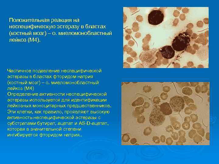 Положительная реакция на неспецифическую эстеразу в бластах (костный мозг) – о. миеломонобластный лейкоз (М