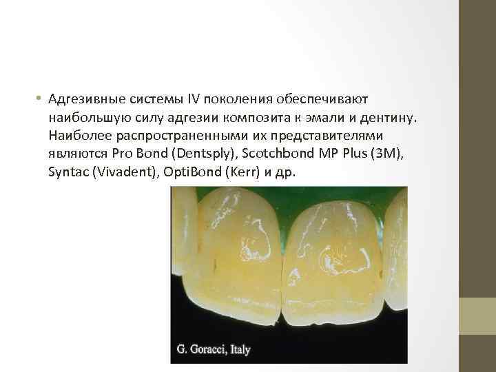  • Адгезивные системы IV поколения обеспечивают наибольшую силу адгезии композита к эмали и