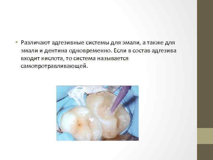  • Различают адгезивные системы для эмали, а также для эмали и дентина одновременно.