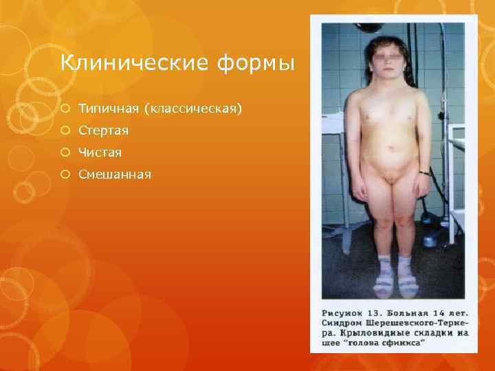 Клинические формы Типичная (классическая) Стертая Чистая Смешанная 