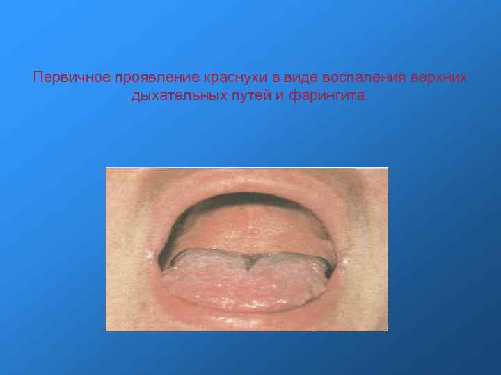 Первичное проявление краснухи в виде воспаления верхних дыхательных путей и фарингита. 