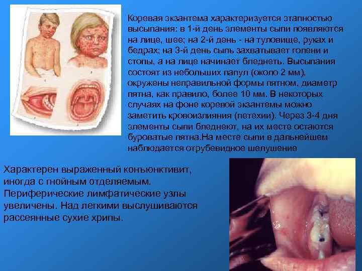 Коревая экзантема характеризуется этапностью высыпания: в 1 -й день элементы сыпи появляются на лице,