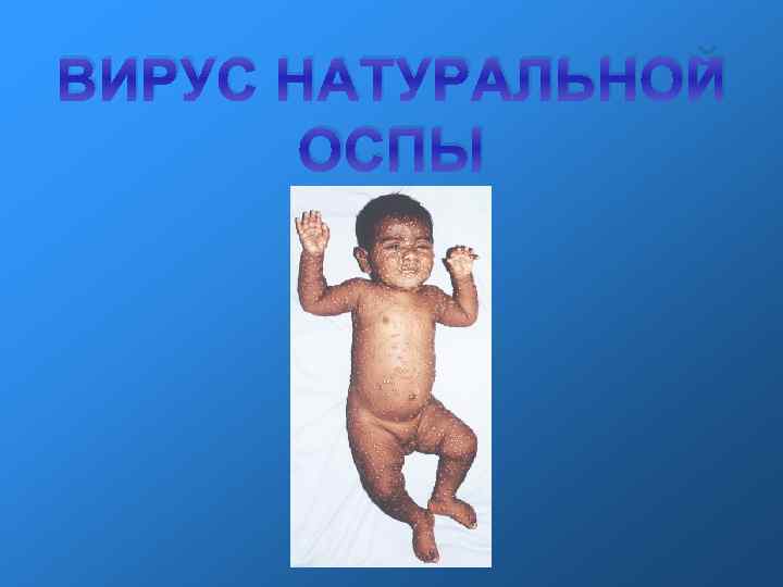 ВИРУС НАТУРАЛЬНОЙ ОСПЫ 