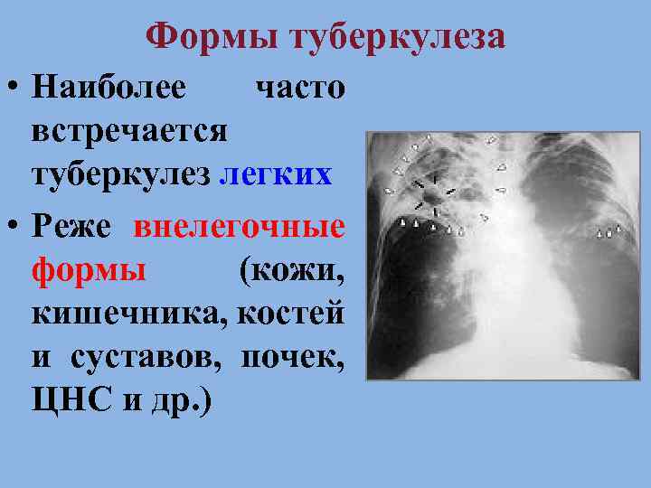 Формы туберкулеза • Наиболее часто встречается туберкулез легких • Реже внелегочные формы (кожи, кишечника,