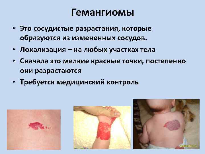 Гемангиомы • Это сосудистые разрастания, которые образуются из измененных сосудов. • Локализация – на
