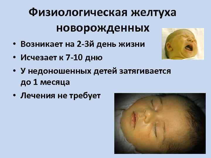 Физиологическая желтуха новорожденных • Возникает на 2 -3 й день жизни • Исчезает к