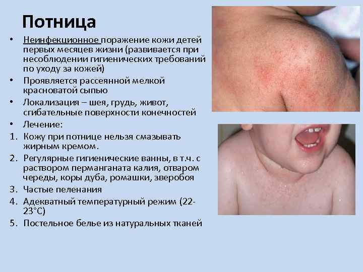 Потница • Неинфекционное поражение кожи детей первых месяцев жизни (развивается при несоблюдении гигиенических требований