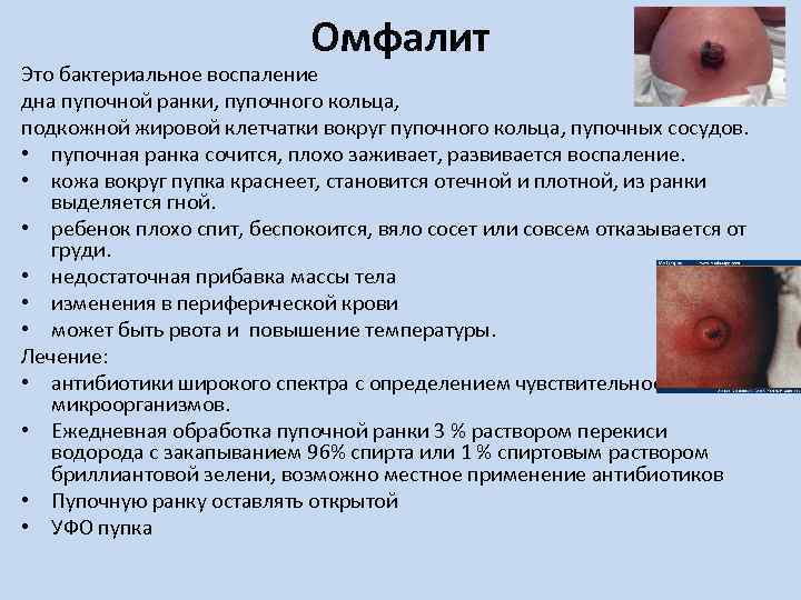 Омфалит Это бактериальное воспаление дна пупочной ранки, пупочного кольца, подкожной жировой клетчатки вокруг пупочного