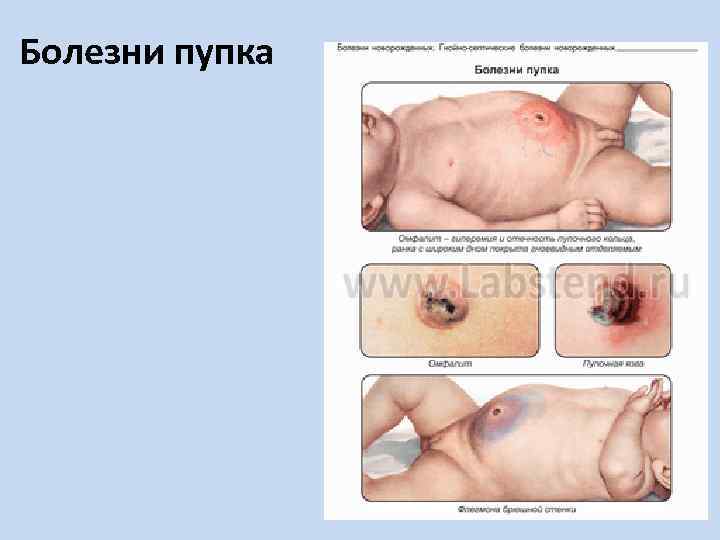Болезни пупка 