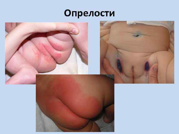 Опрелости 