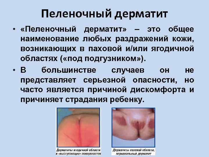 Пеленочный дерматит • «Пеленочный дерматит» – это общее наименование любых раздражений кожи, возникающих в