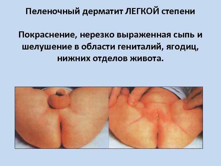 Пеленочный дерматит ЛЕГКОЙ степени Покраснение, нерезко выраженная сыпь и шелушение в области гениталий, ягодиц,