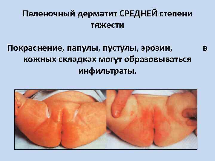 Пеленочный дерматит СРЕДНЕЙ степени тяжести Покраснение, папулы, пустулы, эрозии, в кожных складках могут образовываться