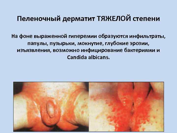 Пеленочный дерматит ТЯЖЕЛОЙ степени На фоне выраженной гиперемии образуются инфильтраты, папулы, пузырьки, мокнутие, глубокие
