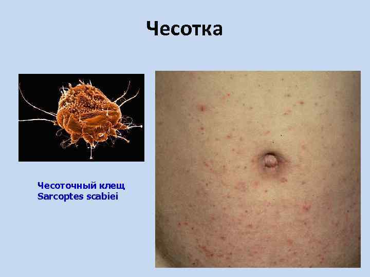 Чесотка Чесоточный клещ Sarcoptes scabiei 