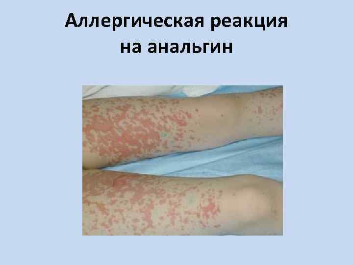 Аллергическая реакция на анальгин 