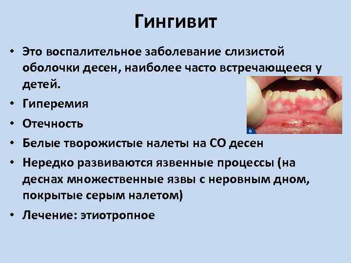 Гингивит • Это воспалительное заболевание слизистой оболочки десен, наиболее часто встречающееся у детей. •