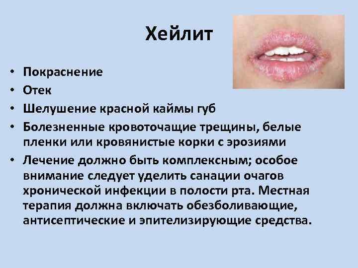 Хейлит Покраснение Отек Шелушение красной каймы губ Болезненные кровоточащие трещины, белые пленки или кровянистые