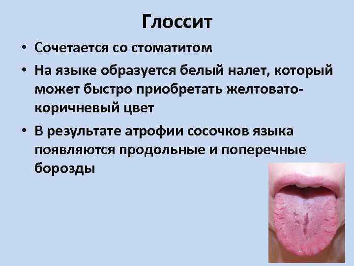 Глоссит • Сочетается со стоматитом • На языке образуется белый налет, который может быстро