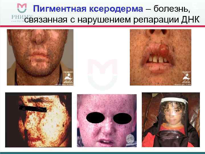Пигментная ксеродерма – болезнь, связанная с нарушением репарации ДНК 