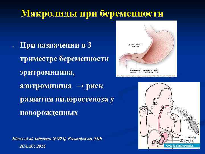 Макролиды при беременности - При назначении в 3 триместре беременности эритромицина, азитромицина → риск