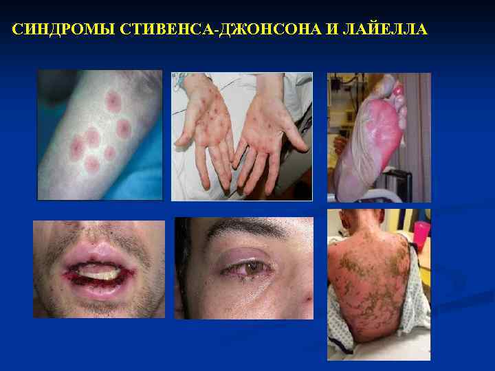 СИНДРОМЫ СТИВЕНСА-ДЖОНСОНА И ЛАЙЕЛЛА 