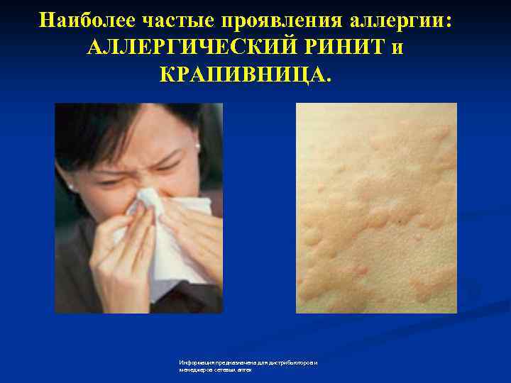 Наиболее частые проявления аллергии: АЛЛЕРГИЧЕСКИЙ РИНИТ и КРАПИВНИЦА. Информация предназначена для дистрибьюторов и менеджеров