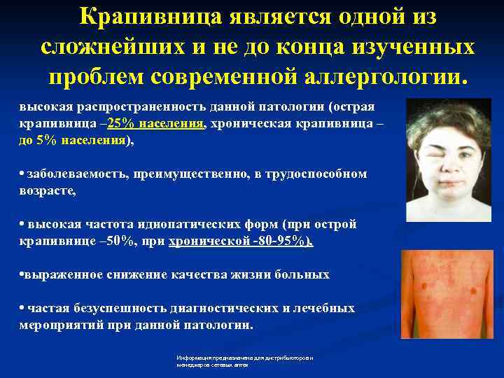 Крапивница является одной из сложнейших и не до конца изученных проблем современной аллергологии. высокая