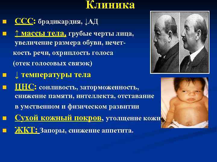 Клиника n n ССС: брадикардия, ↓АД ↑ массы тела, грубые черты лица, увеличение размера