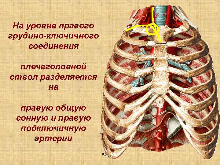 На уровне правого грудино-ключичного соединения плечеголовной ствол разделяется на правую общую сонную и правую