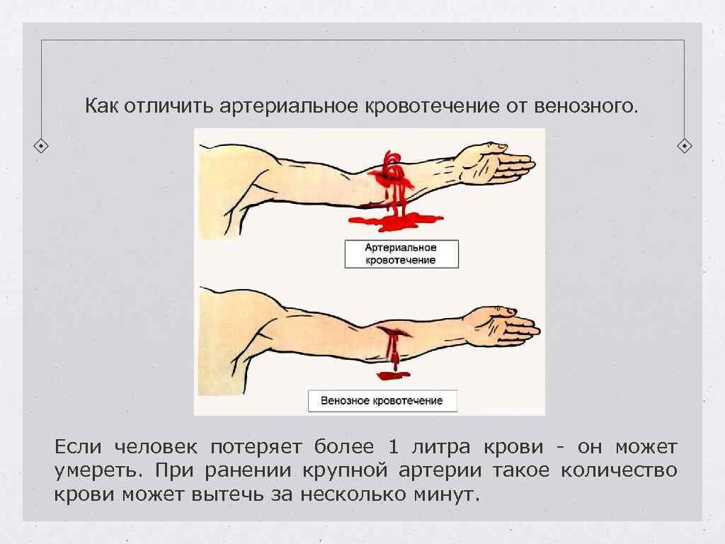 Как отличить артериальное кровотечение от венозного. Если человек потеряет более 1 литра крови -