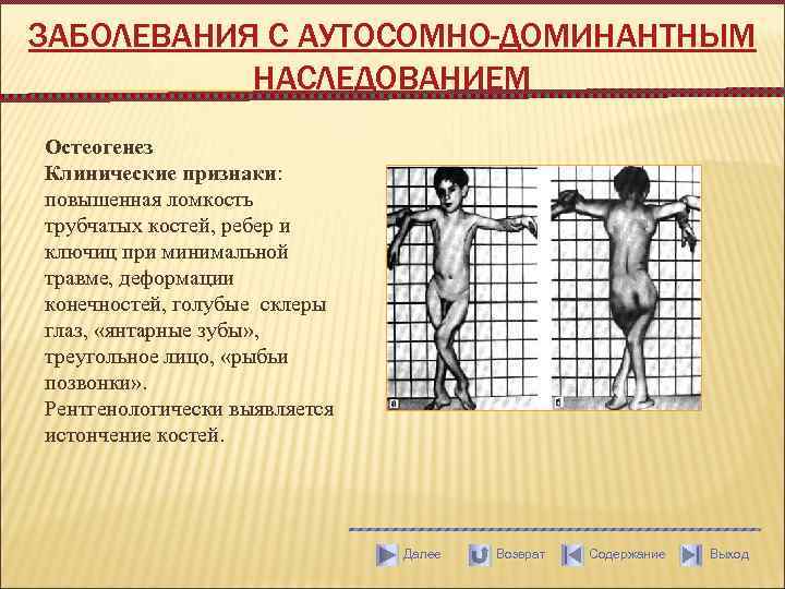 ЗАБОЛЕВАНИЯ С АУТОСОМНО-ДОМИНАНТНЫМ НАСЛЕДОВАНИЕМ Остеогенез Клинические признаки: повышенная ломкость трубчатых костей, ребер и ключиц