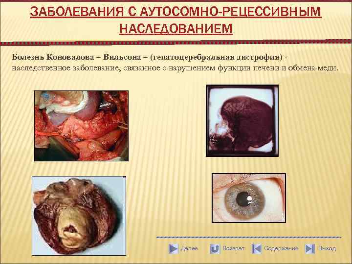 ЗАБОЛЕВАНИЯ С АУТОСОМНО-РЕЦЕССИВНЫМ НАСЛЕДОВАНИЕМ Болезнь Коновалова – Вильсона – (гепатоцеребральная дистрофия) - наследственное заболевание,