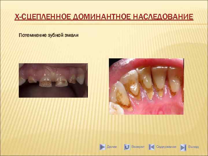 Х-СЦЕПЛЕННОЕ ДОМИНАНТНОЕ НАСЛЕДОВАНИЕ Потемнение зубной эмали Далее Возврат Содержание Выход 