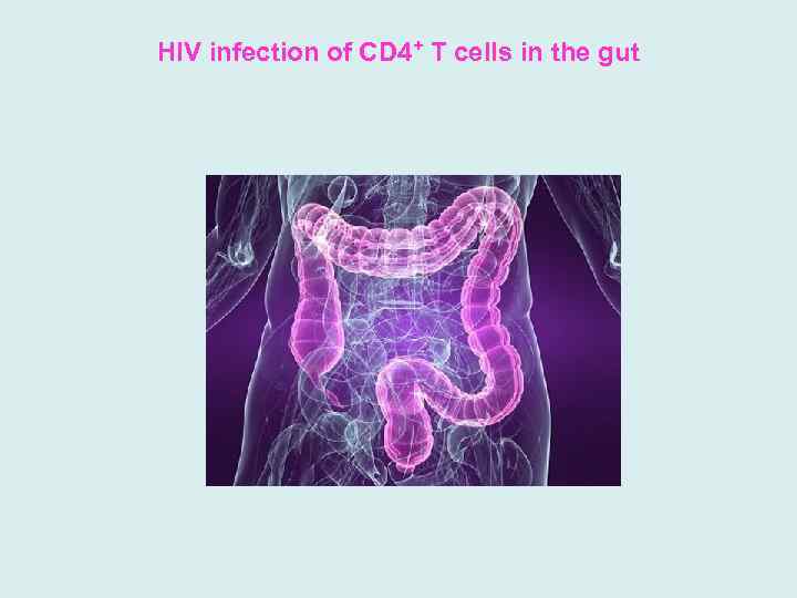 HIV infection of CD 4+ T cells in the gut 